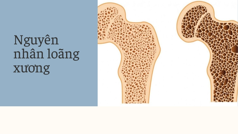 Nguyên nhân gây loãng xương ở mọi lứa tuổi